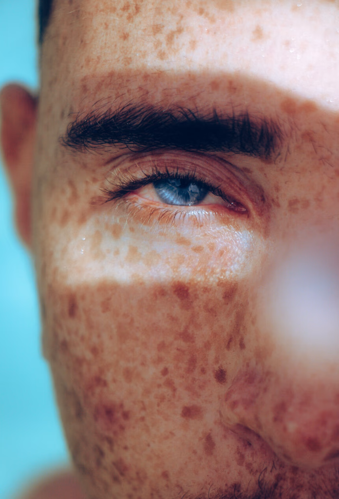 Image of a man with freckles on his face, smiling warmly, showcasing his unique features.